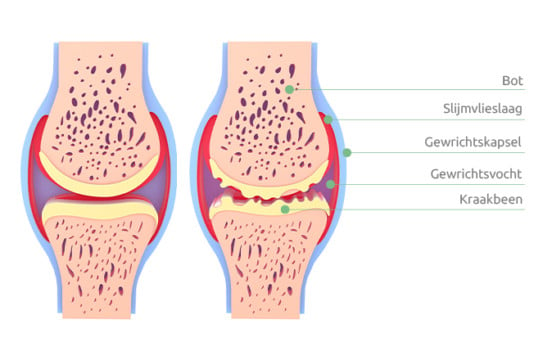 Wat Is Artrose Oorzaken En Symptomen Otolift